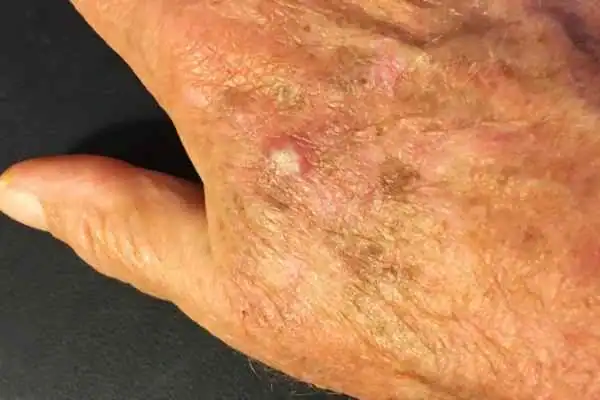 Image of Actinic keratoses Gravesend on a person hand